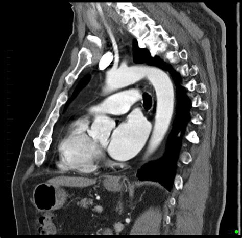 Chest CT Scan - Melbourne Radiology