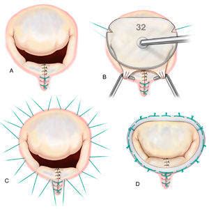 Annuloplasty Rings For Heart Valve Repair Surgery