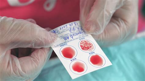 Can Dermatologists Do Blood Tests – EadvVienna2020.org