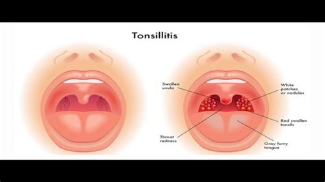 Food Stuck in Throat When You Can Still Breathe - Green Host IT