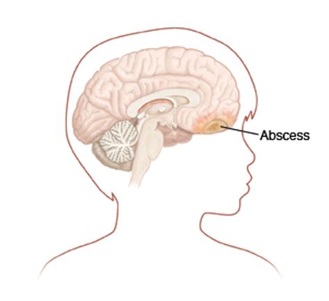 When Your Child Has a Brain Abscess | Saint Luke's Health System