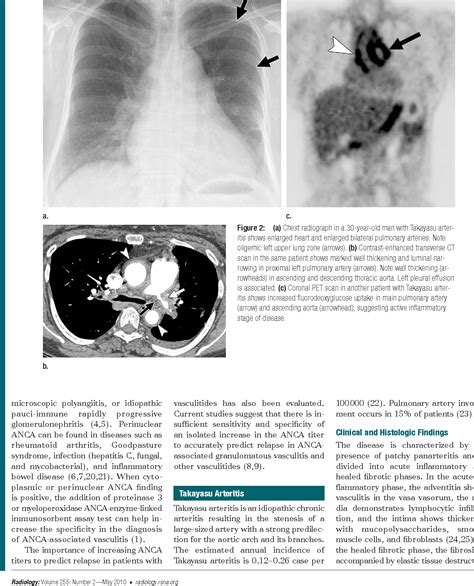 Figure 2 from Imaging of pulmonary vasculitis. | Semantic Scholar