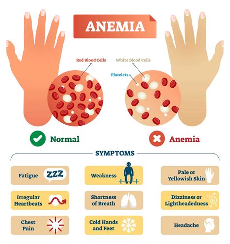 Anemia - Cause, Symptoms, Diagnosis, Treatment - Mobile Physio