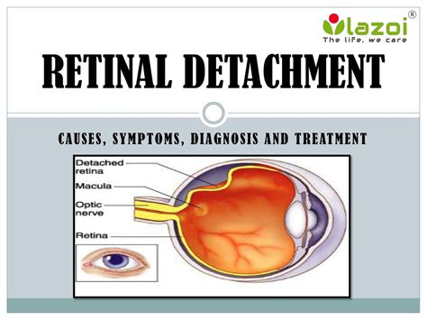 PPT - Retinal Detachment: Causes, Symptoms, Diagnosis and Treatment ...