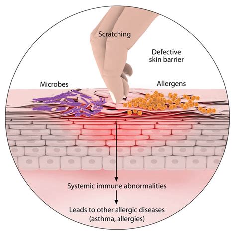 atopic dermatitis cause - pictures, photos