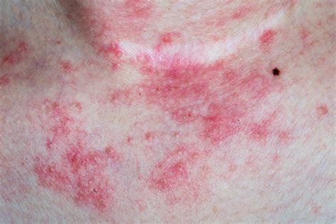 Autoimmune Rashes Pictures - the meta pictures