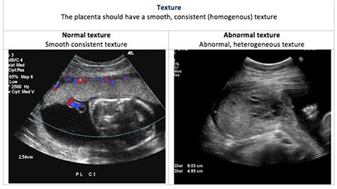 Placental Function Testing - Ontario Fetal Centre