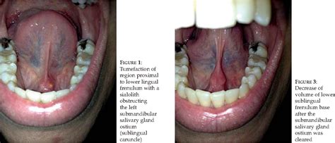 Figure 2 from Rigid swelling of sublingual caruncle area due to the ...