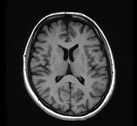 T1 MRI | MRI T1 weighted sequences