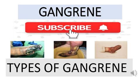 Gangrene #Types of gangrene | PPT