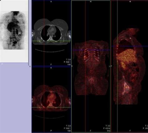 PET-scan for differential diagnosis of lymphoma reveals increased ...