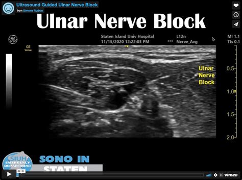 Ultrasound Guided Forearm Ulnar Nerve Block — SIUH Emergency Residency ...