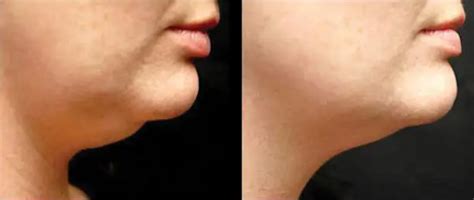 body sculpting before and after | Contour Light Devices