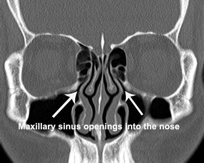 Why do I need a CT scan for my sinuses? - Dr Dharambir S Sethi