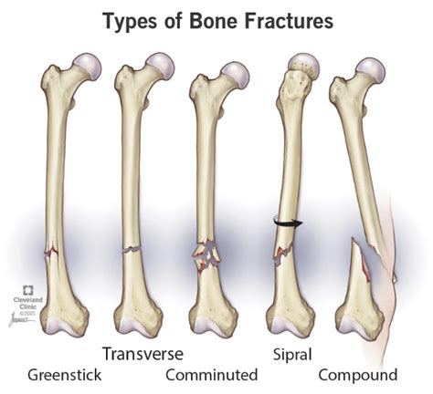 Post Fracture Complications – SP Hospital