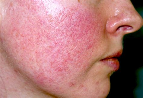 Acne Rosacea Causes and Diagnose - The Natural Cure