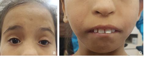 Cureus | Recurrent Ptosis in a Case of Dubowitz Syndrome