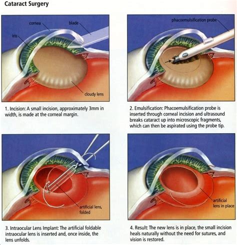 Cataract Surgery - Concord Eye Center