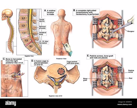 Lower Back Surgery - L5 S1 Lumbar Disc Herniation with Discectomy Stock ...