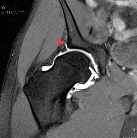 labral tear hip