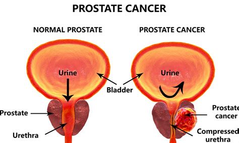 Prostate function, structure, lobes, Benign enlargement of prostate and ...