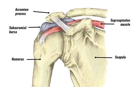 Subacromial Bursitis - Symptoms, Causes, Treatment & Rehabilitation