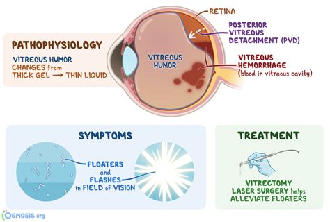 Vitreous Degeneration: What Is It, Causes | Osmosis