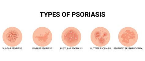 Decoding Psoriasis: Symptoms, Triggers & Blood Tests