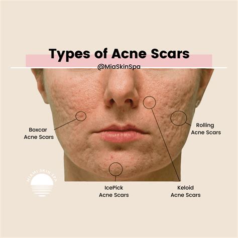 Types of Acne Scars: Pictures, Diagnosis and Treatments