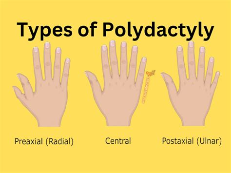 The Fascinating World of a Genetic Abnormality: Polydactyly ...