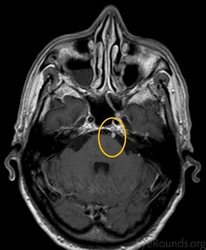 Cranial Nerve 6 (Abducens Nerve) Palsy Secondary to Schwannoma