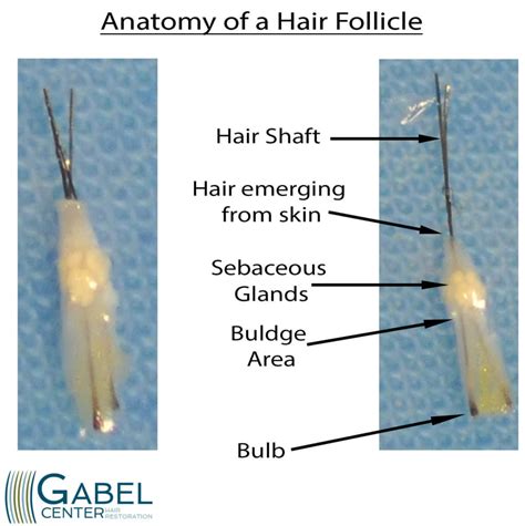 Hair Follicle Anatomy as it relates to hair transplant surgery