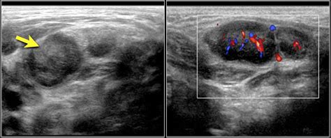 Supraclavicular Lymph Nodes Ultrasound - Ultrasound Of Superficial ...