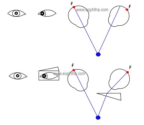 コレクション causes of paralytic exotropia 263579