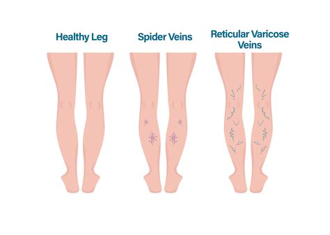 Varicose Veins: Symptoms and Treatment Options — Physicians Vein Clinics