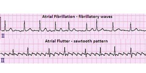 Atrial Flutter- AFs little brother