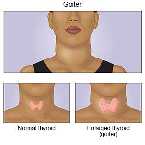 Thyroid Goiter - What You Need to Know