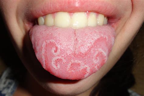 File:Geographic tongue (cropped).jpg - Wikipedia