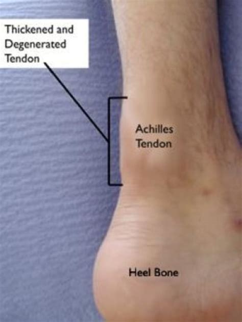 Achilles Tendinitis - OrthoInfo - AAOS