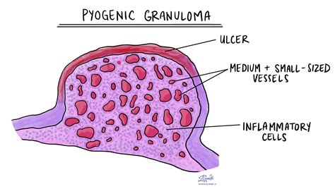 Pyogenic granuloma | MyPathologyReport.ca