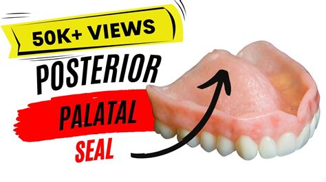 Posterior Palatal Seal (PPS) - YouTube