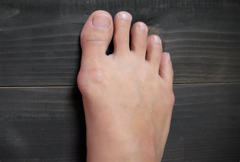 Bunions: Causes, Symptoms, and Medical Treatment