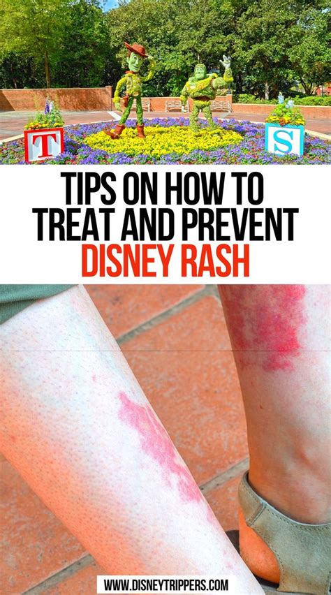 Tips on How To Treat And Prevent Disney Rash | Disney rash, Disney ...