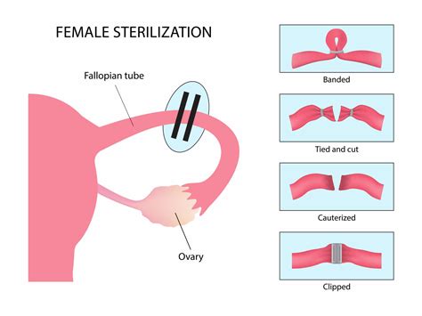 Female Sterilization: How Does it Work and What are the Side Effects?