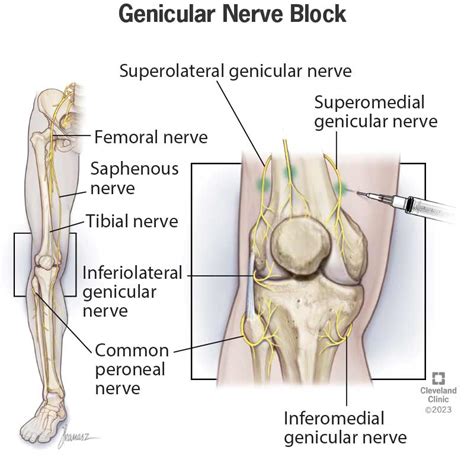 Genicular Nerve Block: What It Is, Procedure & Side Effects