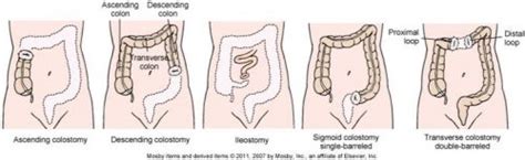 "What is a Stoma?" Part I: Types of Stomas • Young Crohns