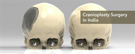 Cranioplasty Surgery Cost in India, Cranioplasty Surgery, Cranioplasty Cost