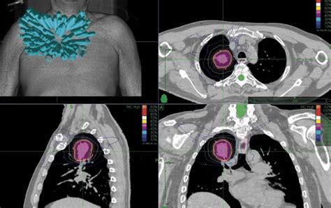 Stereotactic Body Radiation Therapy (SBRT) Revolution in Lung ...