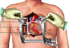 Cardiothoracic ICU | All Things NP