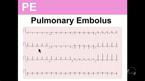 Pe ecg findings - lopezcube